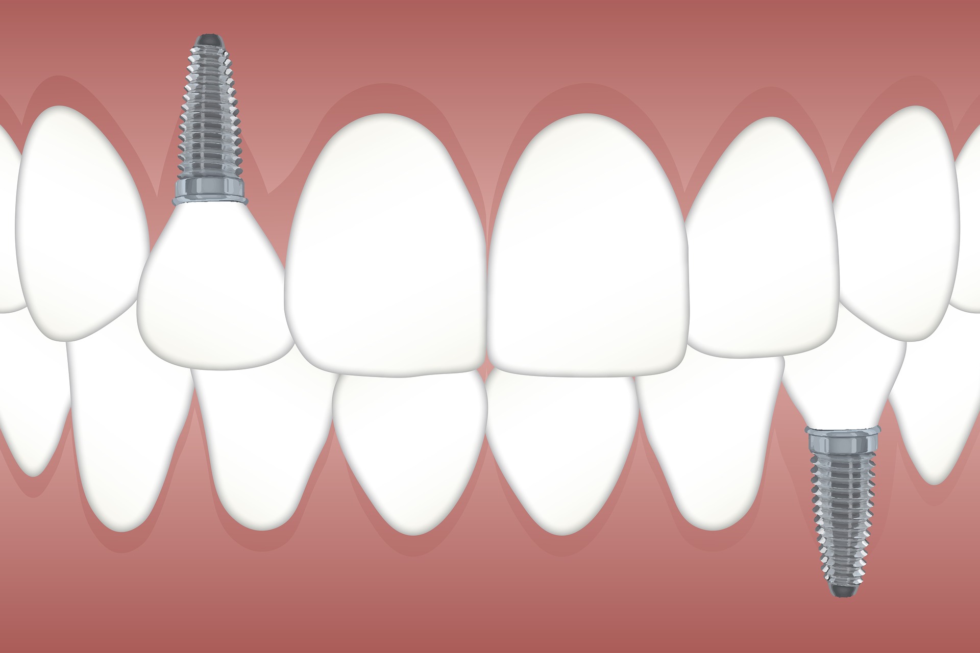 歯の欠損放置は危険！インプラント治療は早めの決断が大事！