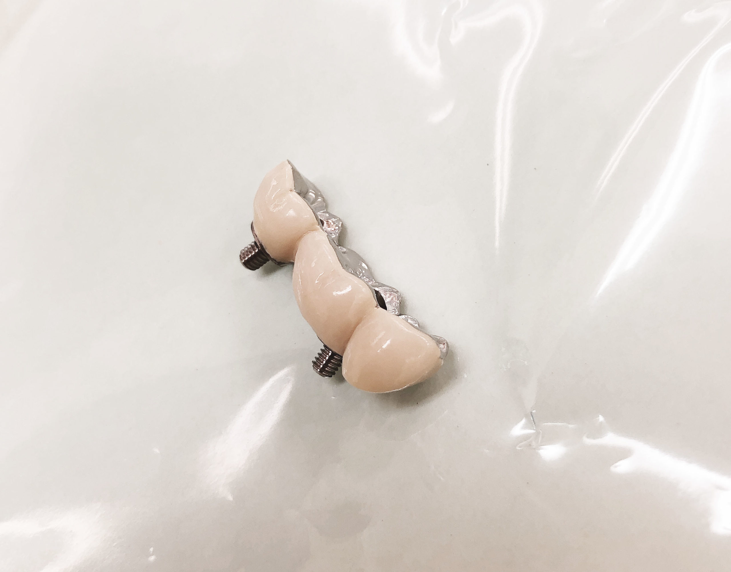 インプラント人工歯完成！装着時の噛み合わせ調整と日常的な使用感を解説